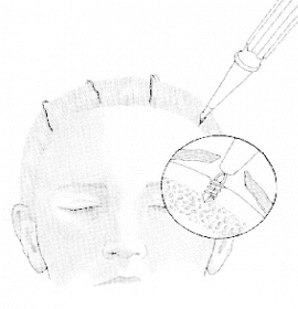 Endoscopic brow lift — step 8