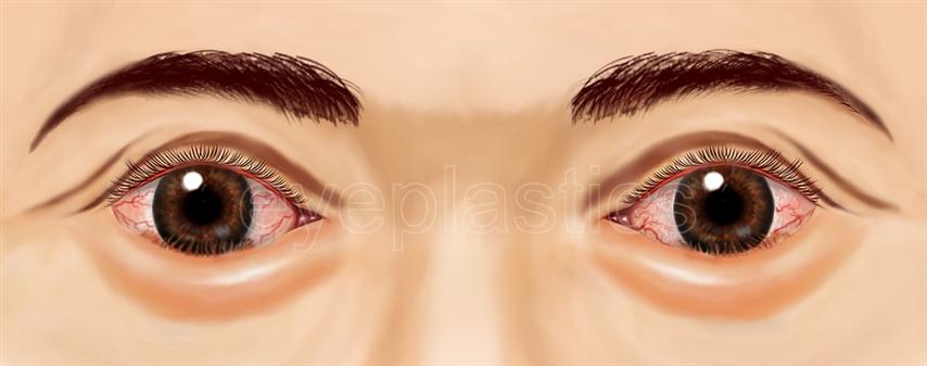 Clinical photograph of entropion — lower eyelid turning inward
