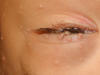 Molluscum contagiosum lesions on the eyelid