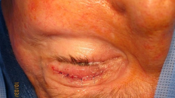 Skin incision closed after gold weight implantation