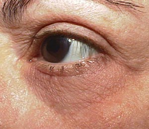 Laser resurfacing — pre-operative assessment