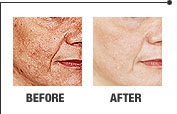 Laser skin rejuvenation result 1