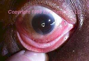 Orbital lymphoma salmon-patch conjunctival lesion