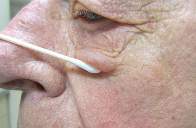 Rosacea — periocular involvement