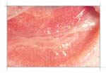 Symblepharon — conjunctival adhesion
