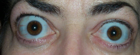 Thyroid eye disease — orbital CT