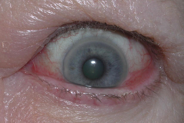 TED orbital scan showing enlarged muscles